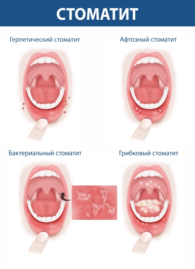 Лечение стоматита на десне — Чем лечить? | Блог стомпрактика.рф